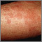 Ronchas (urticaria) en el brazo