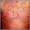 Ronchas (urticaria) en el pecho