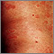 Ronchas (urticaria) en el tronco