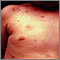 Urticaria pigmentosa en el tórax