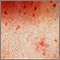 Urticaria pigmentosa - vista de cerca