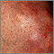 Xantoma de la rodilla
