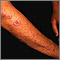 Liquen plano en el brazo
