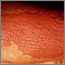Liquen simple crónico