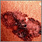 Cáncer de piel - melanoma de propagación superficial