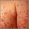Psoriasis - guttata en los brazos y el tórax