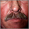 Salpullido facial por lupus eritematoso sistémico