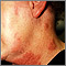 Herpes zoster (culebrilla) en cuello y mejilla