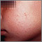 Queratosis pilaris de la mejilla