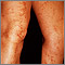 Livedo reticularis en las piernas