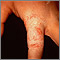 Dermatofitosis - tiña de la mano en el dedo