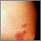 Sarcoidosis en el codo