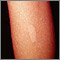 Esclerosis tuberosa - mácula hipopigmentada