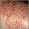 Granuloma por hongos (de Majocchi)