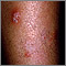 Granuloma por hongos (de Majocchi)