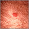Sarcoma de Kaposi - perianal