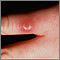Leishmaniasis en el dedo de la mano