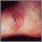 Leishmania panamensis en el pie