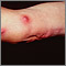 Esporotricosis en el brazo