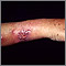 Esporotricosis en el antebrazo