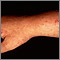 Erupción leve y poliforme del brazo