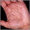 Hiperlinearidad de la dermatitis atópica