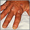 Psoriasis en los nudillos