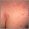 Urticaria en espalda y glúteos