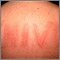 Dermatografismo de la espalda