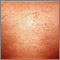 Urticaria en el tórax