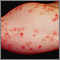 Dermatitis herpetiforme en el antebrazo