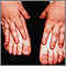 Epidermólisis bullosa, distrófica