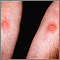 Examen de piel - PPD (brazo derecho) y Candida (izquierdo)