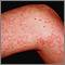 Granulomatosis con poliangitis en la pierna