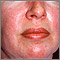 Dermatomiositis - erupción heliotrope en la cara