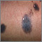 Nevo congénito en el abdomen