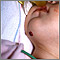 Hemangioma del mentón