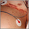 Herpes zóster diseminado