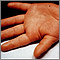Enfermedad de Kawasaki - edema de la mano