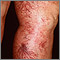 Telangiectasia en las piernas