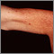 Telangiectasias en el antebrazo