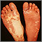 Síndrome de Sturge-Weber - plantas de los pies