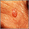 Carcinoma de célula basal en la cara