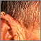 Queratosis actínica en el oído