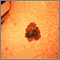 Melanoma del cuello