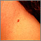 Queratosis seborreica irritada en el cuello