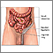 Reparación quirúrgica de una hernia inguinal - serie