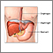Reparación quirúrgica de una hernia hiatal - serie