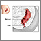 Reparación quirúrgica de prolapso rectal - serie