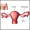 Ligadura de trompas - anatoma uterine